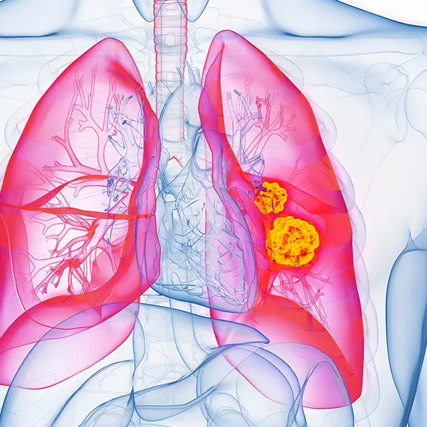 肺腺癌的基因分析